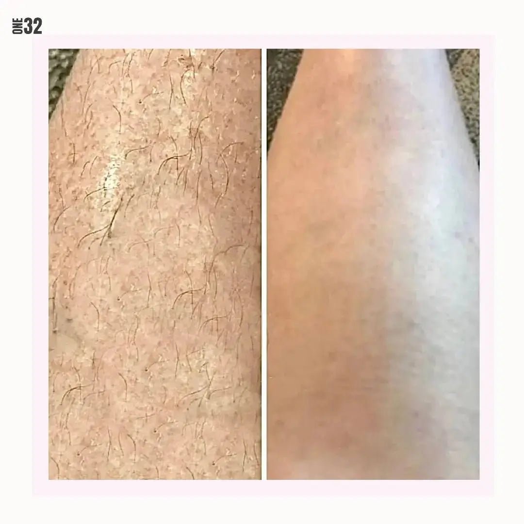 ONE32 IPL laser hair removal device - ONE32