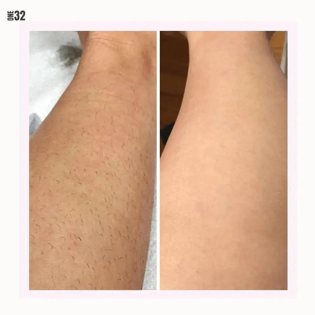 ONE32 - IPL Laser Hair Removal Device - ONE32